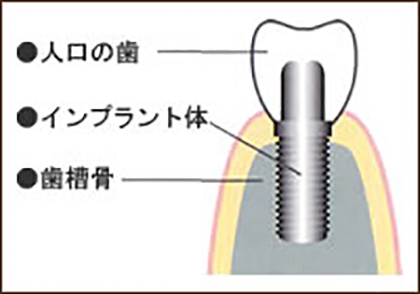 インプラント治療とは？