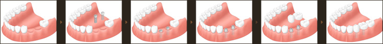 インプラントでの治療