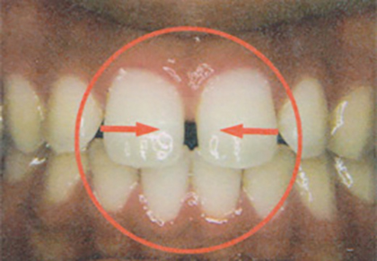歯の隙間を閉じる臨床例