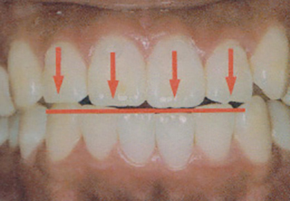 歯の高さを揃える臨床例（抽出）