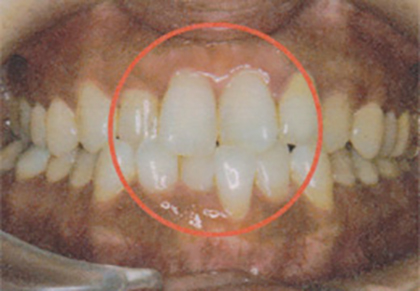歯並び改善の臨床例