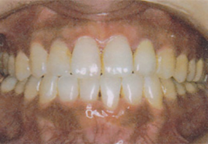 歯並び改善の臨床例