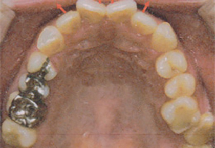 歯並び改善の臨床例