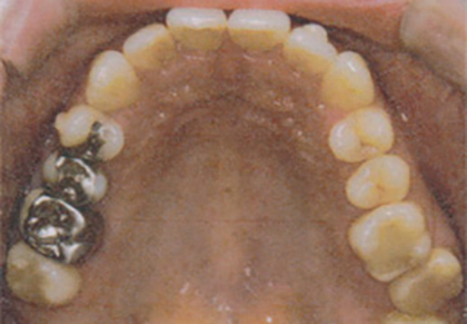 歯並び改善の臨床例